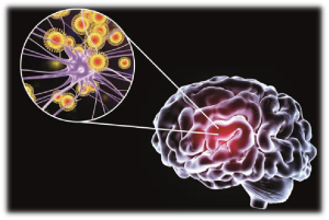 CHẨN ĐOÁN VIÊM NÃO DO HERPES SIMPLEX BẰNG CỘNG HƯỞNG TỪ (MRI)